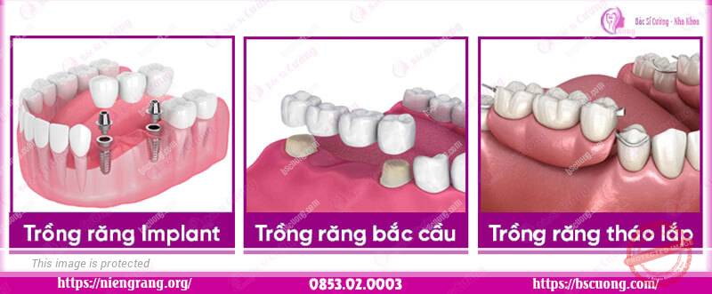 Các phương pháp trồng răng nha khoa bác sĩ cường