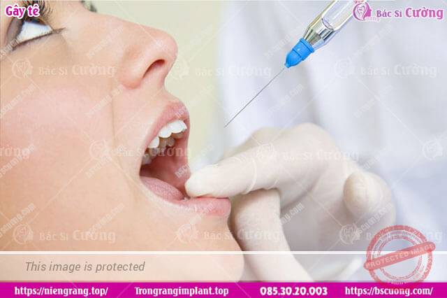 gây tê giúp giảm đau trong điều trị bệnh lý răng tủy răng, bọc răng sứ trồng răng implant bác sĩ cường