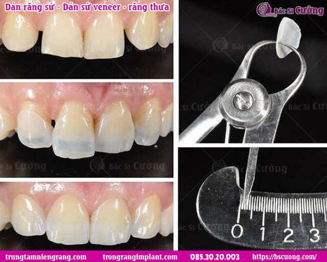 dan-rang-su-dan-su-veneer-rang-cua-thua-tham-my