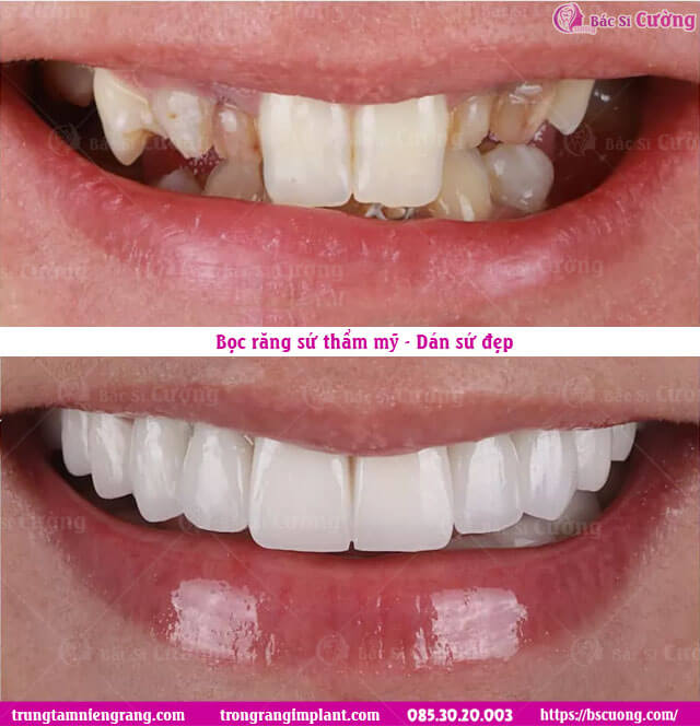 boc-rang-su-tham-my-dan-su-veneer-bac-si-cuong-nha-khoa-tp-hcm