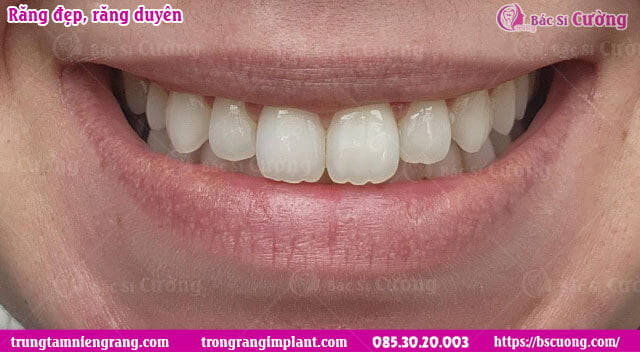 nieng-rang-tho-bac-si-cuong-nha-khoa-uy-tin-tp-hcm