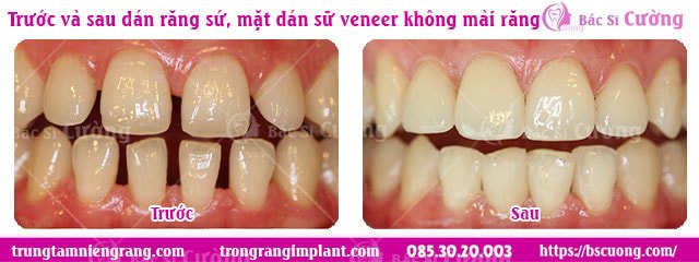 Truoc-va-sau-dan-rang-su-mat-dan-su-veneer-khong-mai-rang-bs-cuong