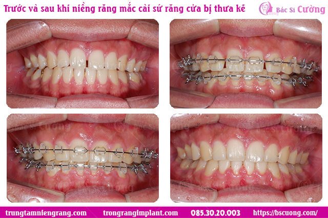 nieng-rang-thua-mat-bao-lau-bang-mac-cai-su-Truoc-va-sau-khi-nieng-rang-mac-cai-su-rang-cua-bi-thua-2-rang-cua-bs-cuong-hcm-Bs-Cuong
