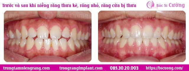 nieng-rang-thua-mat-bao-lau-Truoc-va-sau-khi-nieng-rang-thua-ke-rang-nho-rang-cua-bi-thua-bs-cuong-hcm