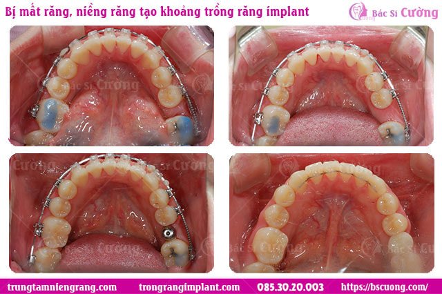 mat-rang-co-nieng-duoc-khong-trong-rang-co-nieng-duoc-khong-trong-rang-implant-sau-khi-nieng-bs-cuong-Bs-Cuong