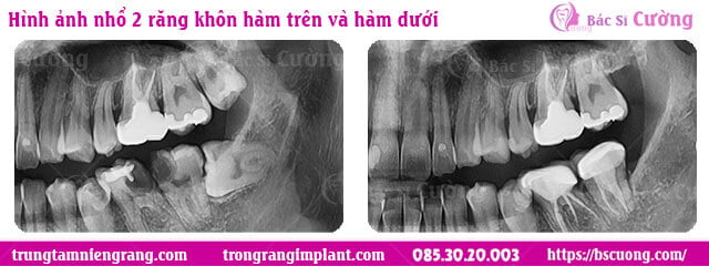 truoc-va-sau-nho-rang-khon-ham-tren-ham-duoi-bs-cuong-nha-khoa-kham-rang-tphcm
