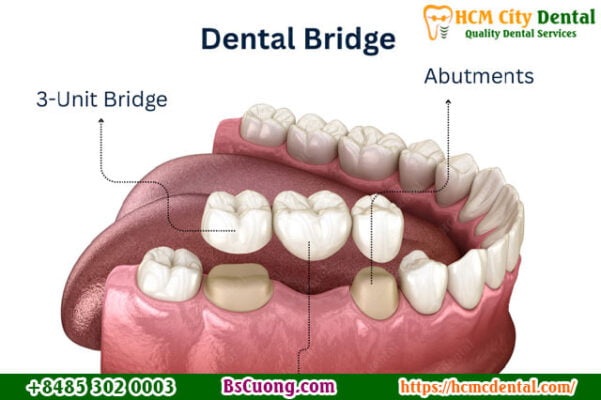 Dental-bridge-Dr-Cuong-HCMC-dental-clinic