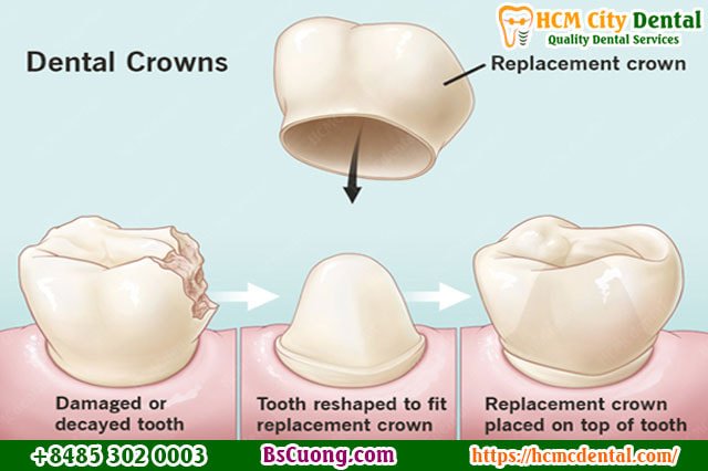 Dental-crown-Dr-Cuong-HCMC-dental-clinic.jpg