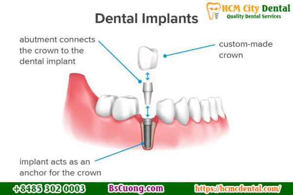 Dental-implants-cost-Dr-Cuong-HCMC-dental-clinic