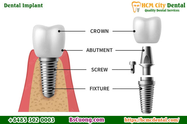 dental-implant-hcmcdental-Dr-Cuong-HCMC-dental-clinic