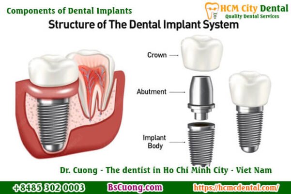 Components-of-Dental-Implants-drcuong-hcmcdental