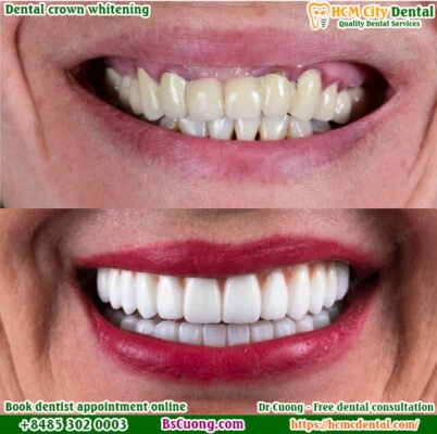Dental-crown-whitening-before-after-drcuong-hcm