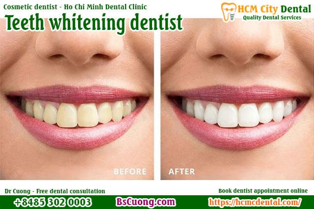 Teeth-whitening-dentist-drcuong-hcmcdental-Cosmetic-dentist