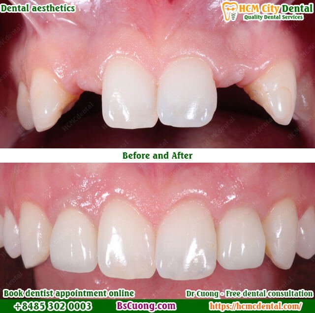 Are Dental Implants the Right Choice? A Comprehensive Guide 7 dental-aesthetics-implant-crown-drcuong