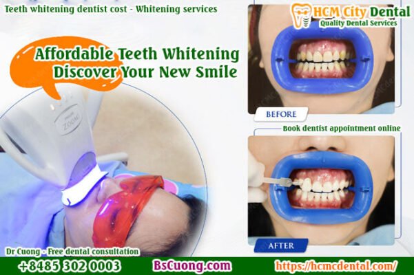 teeth-whitening-dentist-cost-Whitening-services-drcuong-hcmcdental