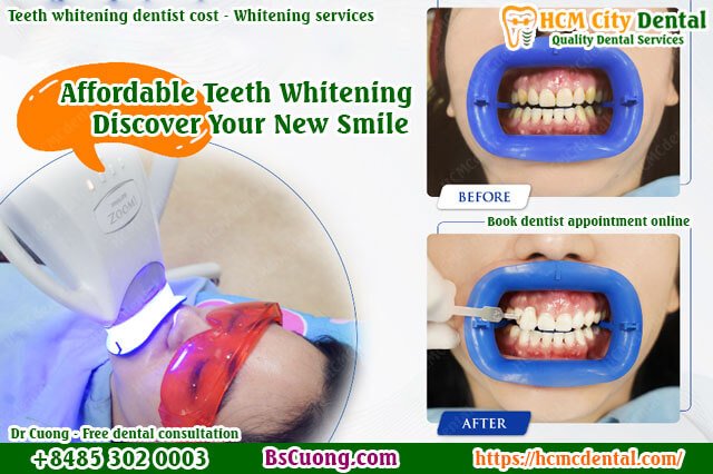 teeth-whitening-dentist-cost-Whitening-services-drcuong-hcmcdental