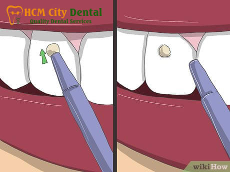 cach-gan-da-vao-rang-2-bac-si-cuong-nha-khoa-bscuong-bac-si-cuong-nha-khoa-bscuong