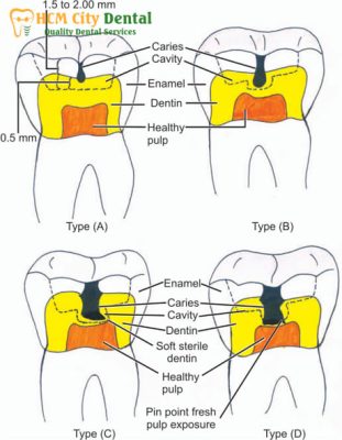 muc-do-sau-rang-1-bac-si-cuong-nha-khoa-bscuong