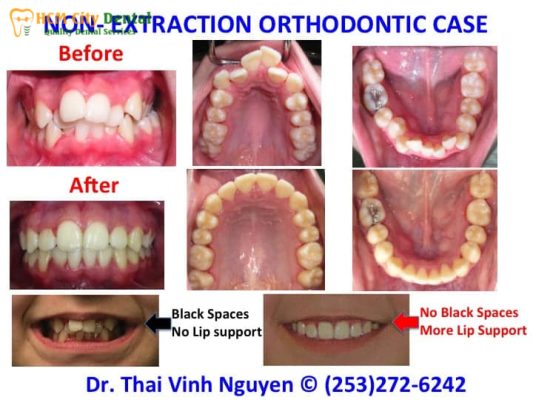 nieng-rang-khong-nho-rang-co-hieu-qua-khong-1-bac-si-cuong-nha-khoa-bscuong