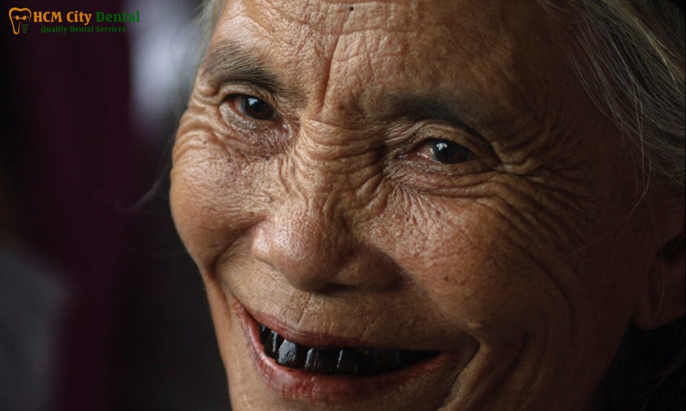 rang-bi-den-6-bac-si-cuong-nha-khoa-bscuong-bac-si-cuong-nha-khoa-bscuong
