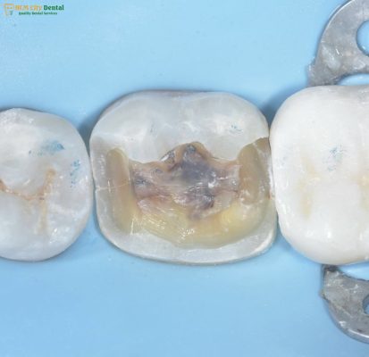 rang-bi-nut-ngang-1-bac-si-cuong-nha-khoa-bscuong