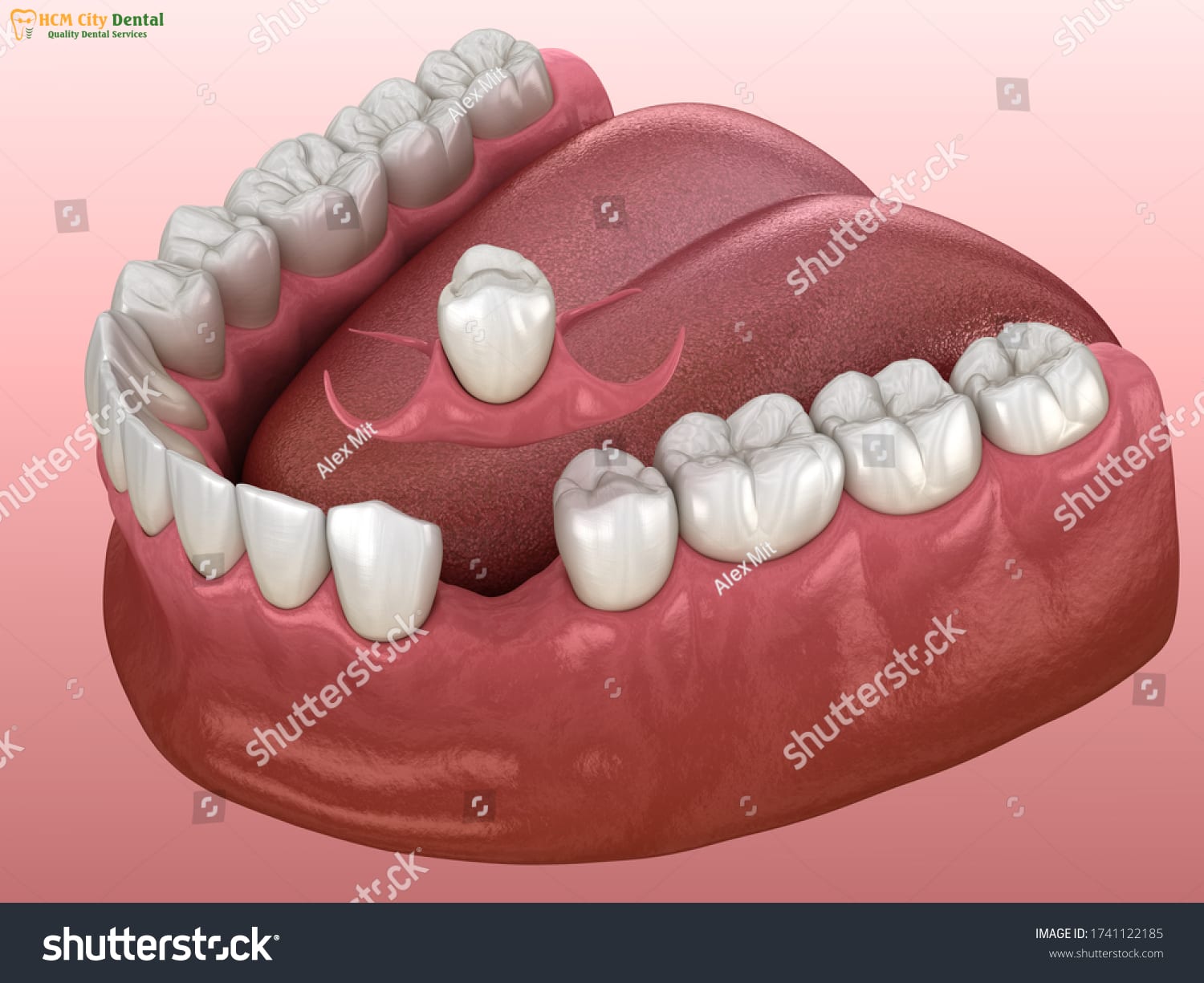 rang-canh-buom-6-bac-si-cuong-nha-khoa-bscuong-bac-si-cuong-nha-khoa-bscuong