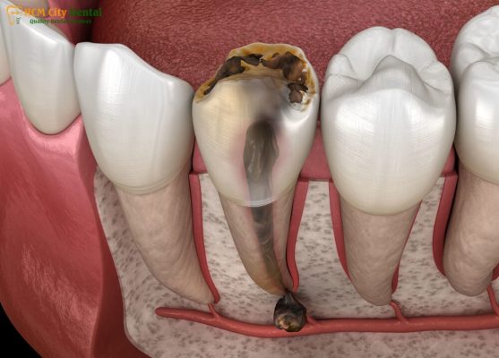 rang-chet-tuy-1