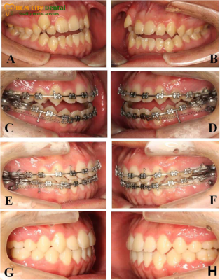 tac-dung-cua-minivis-trong-nieng-rang-1-bac-si-cuong-nha-khoa-bscuong
