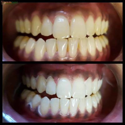 tay-trang-rang-bang-laser-whitening-co-hai-khong-1-bac-si-cuong-nha-khoa-bscuong