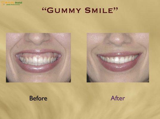 tiem-botox-cuoi-ho-loi-1-bac-si-cuong-nha-khoa-bscuong