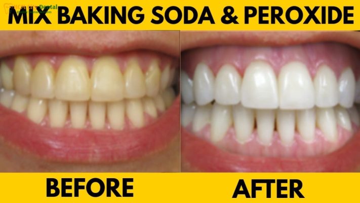 baking-soda-lam-trang-rang-1-bac-si-cuong-nha-khoa-bscuong