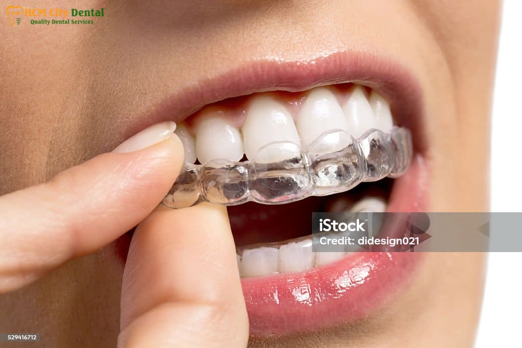 cach-deo-nieng-rang-silicon-6-bac-si-cuong-nha-khoa-bscuong-bac-si-cuong-nha-khoa-bscuong