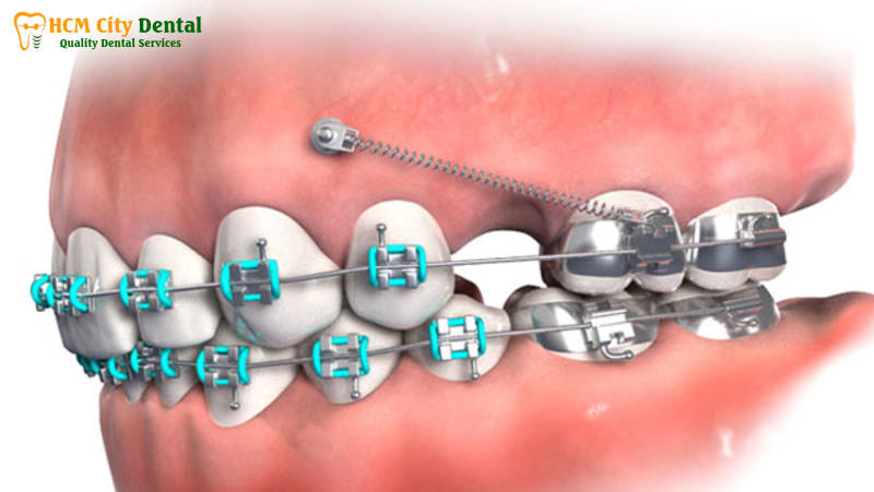 cam-minivis-bi-sung-2-bac-si-cuong-nha-khoa-bscuong-bac-si-cuong-nha-khoa-bscuong