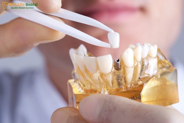 cay-rang-implant-bao-nhieu-tien-1-bac-si-cuong-nha-khoa-bscuong