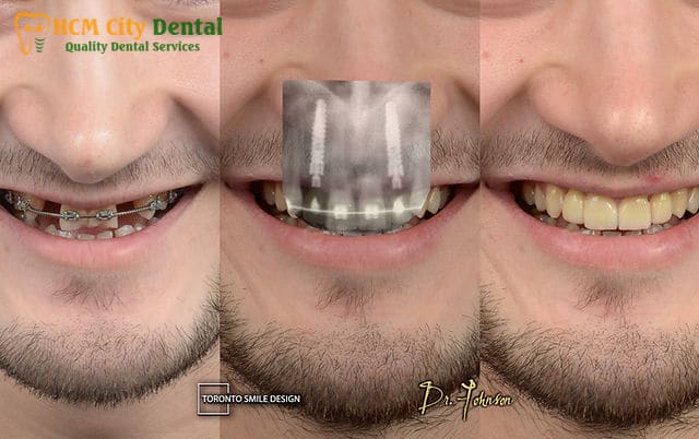 cay-rang-implant-bao-nhieu-tien-2-bac-si-cuong-nha-khoa-bscuong-bac-si-cuong-nha-khoa-bscuong