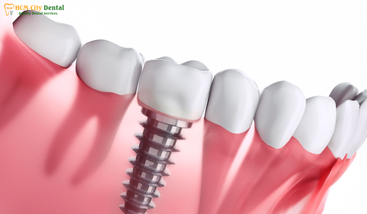 cay-rang-implant-bao-nhieu-tien-3-bac-si-cuong-nha-khoa-bscuong-bac-si-cuong-nha-khoa-bscuong