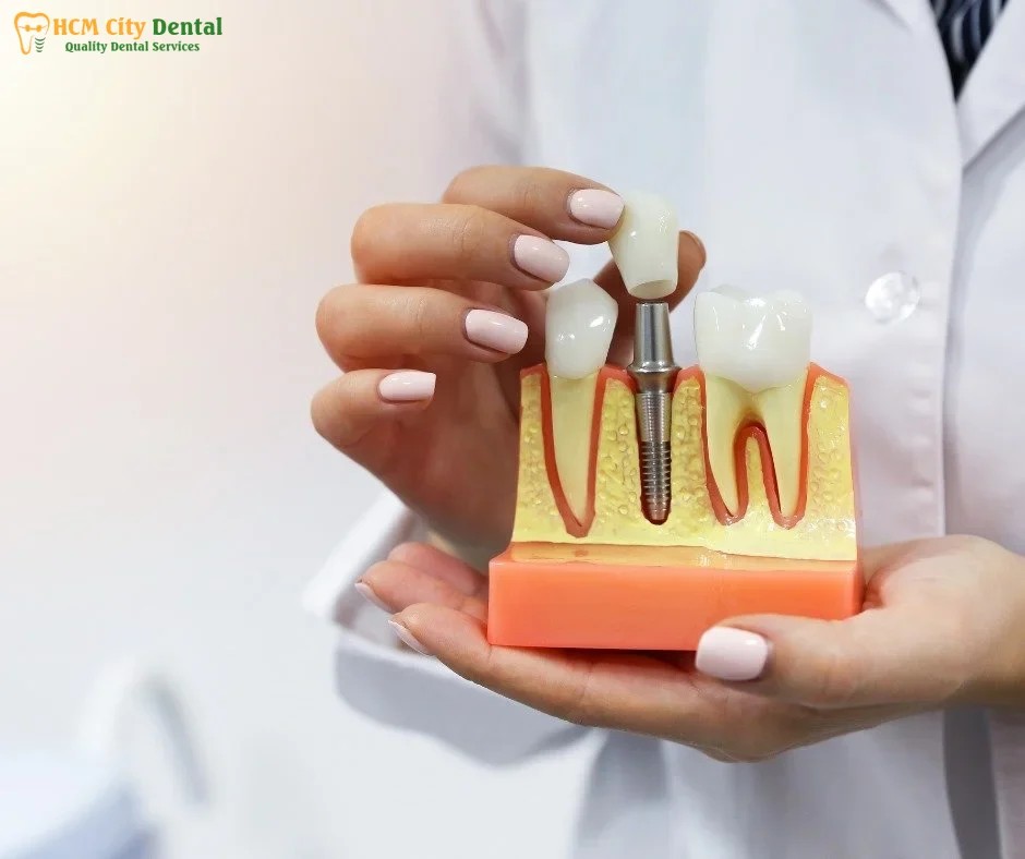 cay-rang-implant-bao-nhieu-tien-4-bac-si-cuong-nha-khoa-bscuong-bac-si-cuong-nha-khoa-bscuong