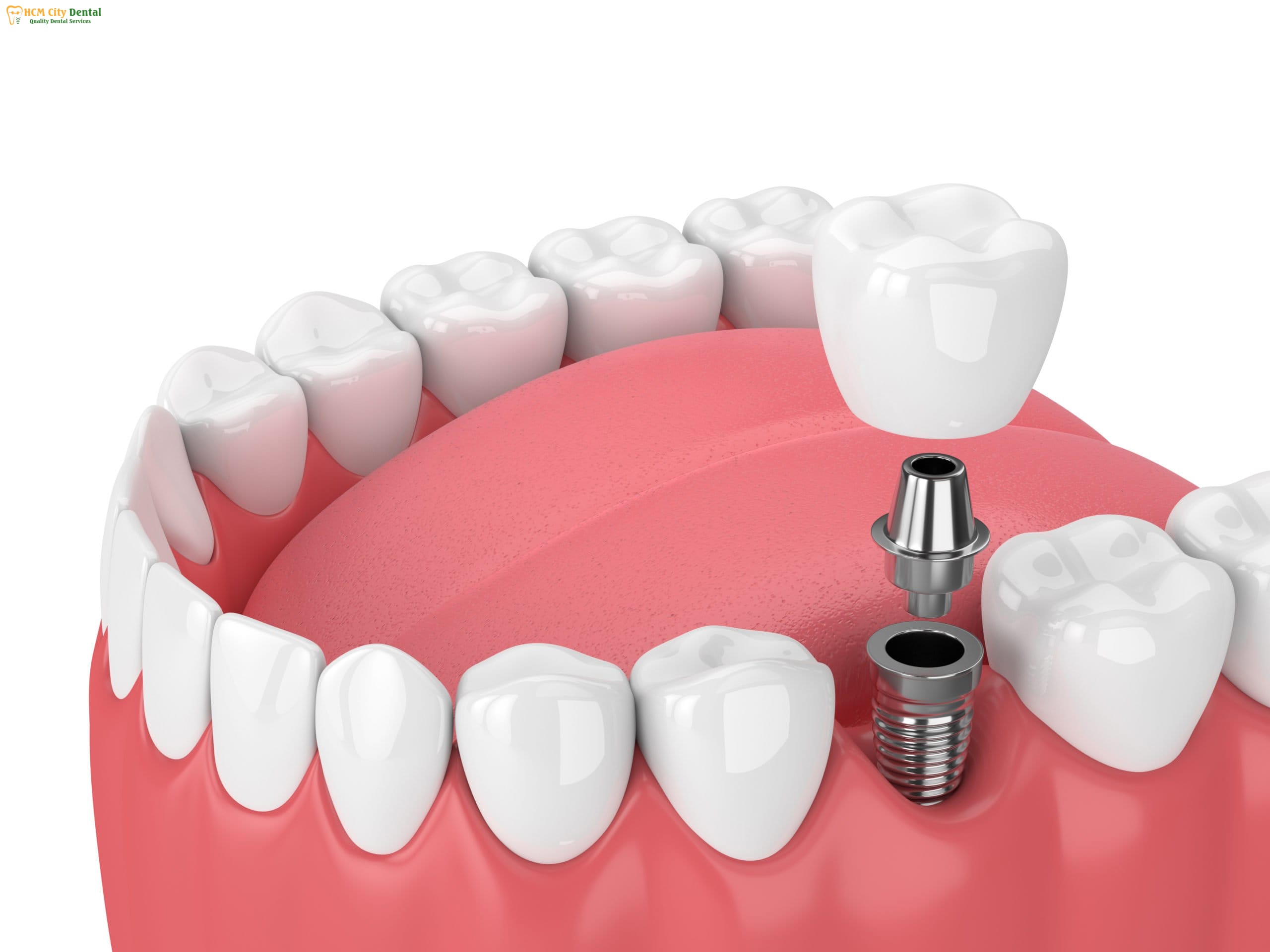 cay-rang-implant-bao-nhieu-tien-5-bac-si-cuong-nha-khoa-bscuong-bac-si-cuong-nha-khoa-bscuong