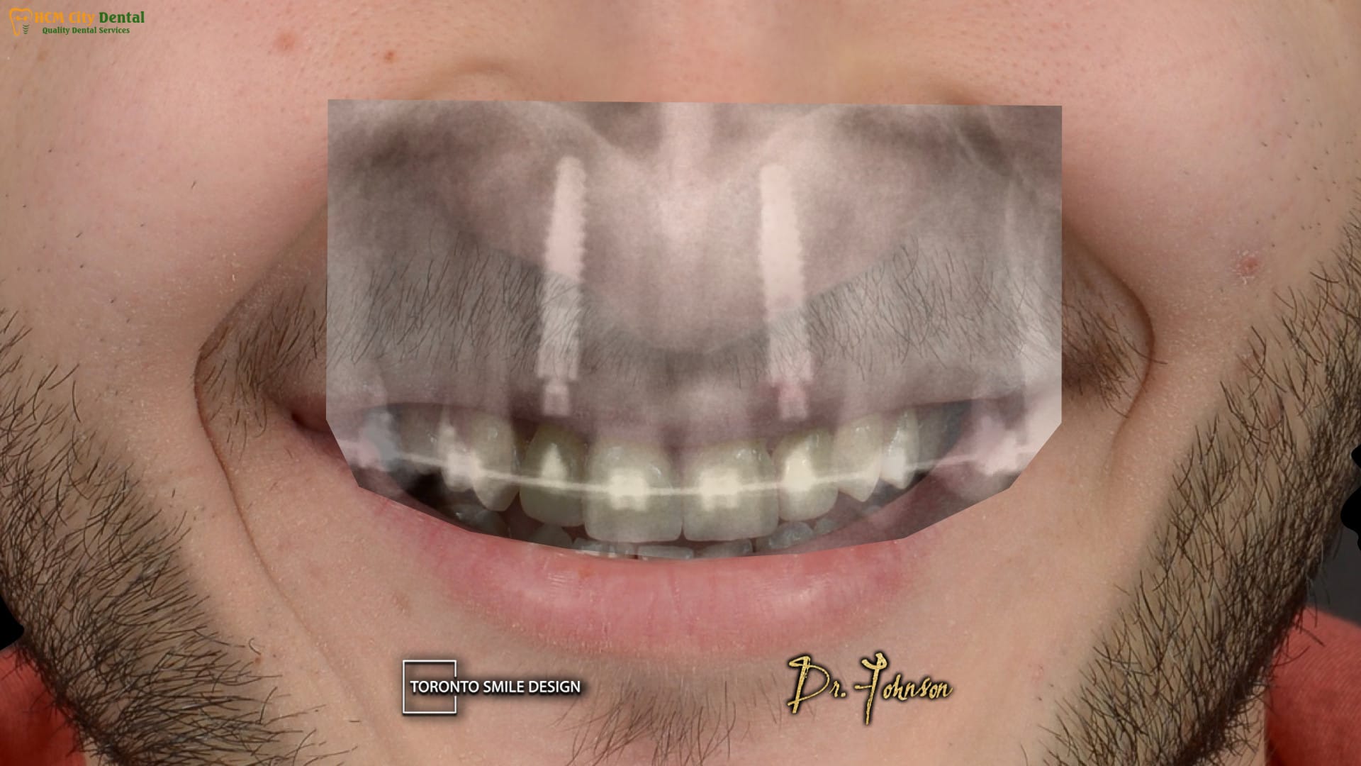 cay-rang-implant-bao-nhieu-tien-6-bac-si-cuong-nha-khoa-bscuong-bac-si-cuong-nha-khoa-bscuong