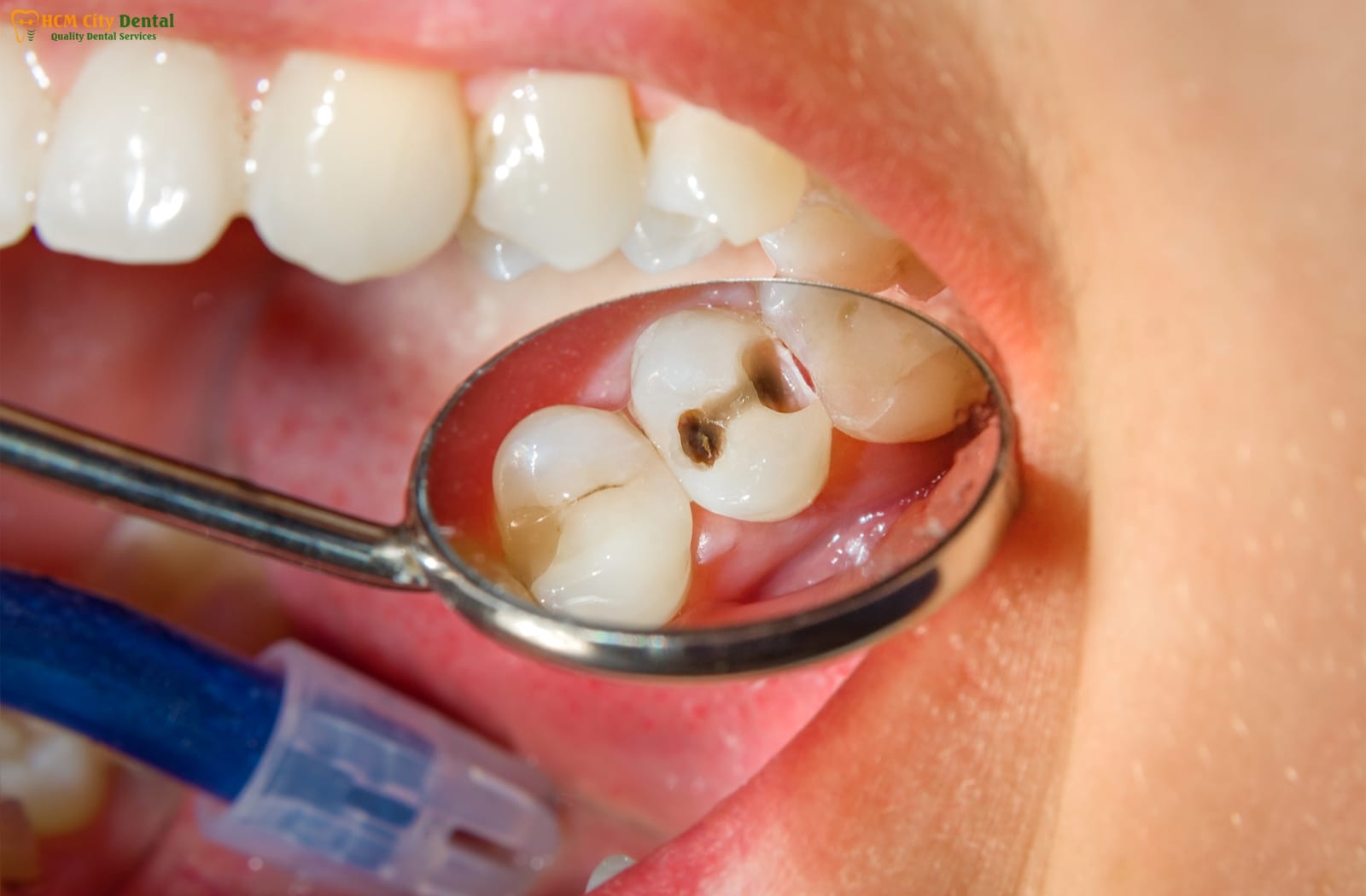 lam-sao-de-het-sau-rang-2-bac-si-cuong-nha-khoa-bscuong-bac-si-cuong-nha-khoa-bscuong