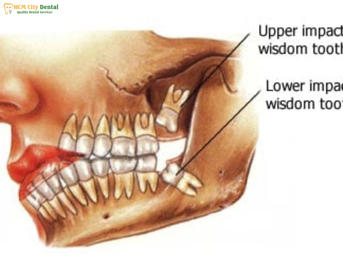 nho-rang-khon-co-anh-huong-gi-khong-4-bac-si-cuong-nha-khoa-bscuong-bac-si-cuong-nha-khoa-bscuong