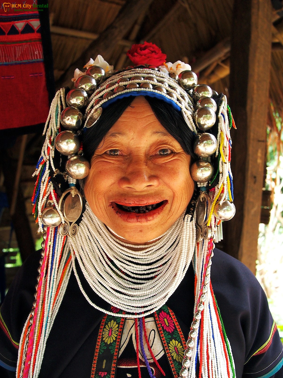 nhuom-rang-den-1-bac-si-cuong-nha-khoa-bscuong-bac-si-cuong-nha-khoa-bscuong