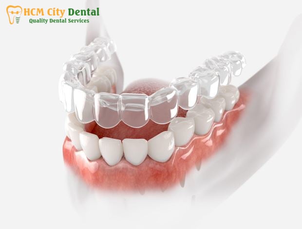 nieng-rang-trong-suot-clear-aligner-2-bac-si-cuong-nha-khoa-bscuong-bac-si-cuong-nha-khoa-bscuong