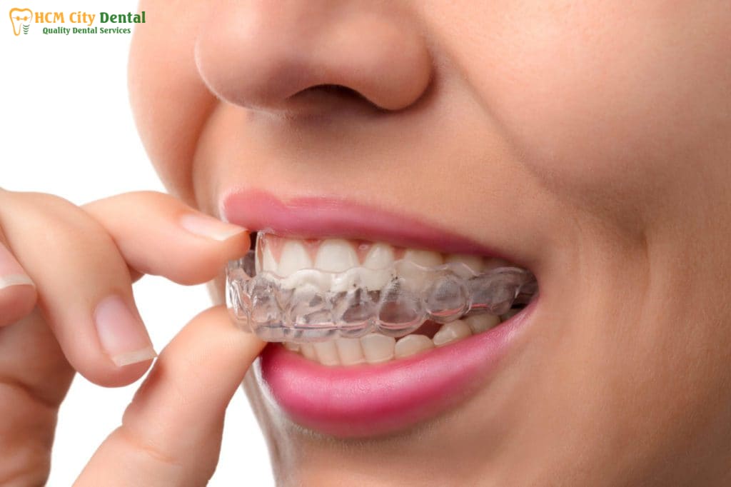 nieng-rang-trong-suot-clear-aligner-5-bac-si-cuong-nha-khoa-bscuong-bac-si-cuong-nha-khoa-bscuong