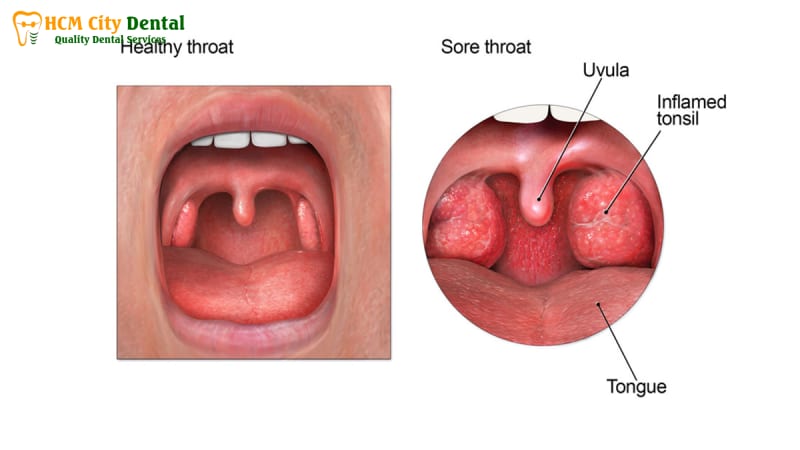 nuot-nuoc-bot-dau-hong-4-bac-si-cuong-nha-khoa-bscuong-bac-si-cuong-nha-khoa-bscuong