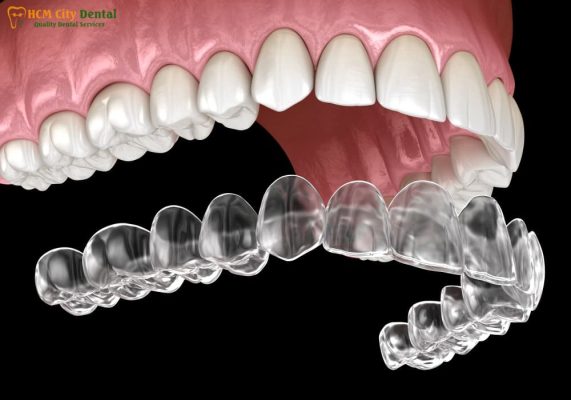 quy-trinh-nieng-rang-invisalign-1-bac-si-cuong-nha-khoa-bscuong