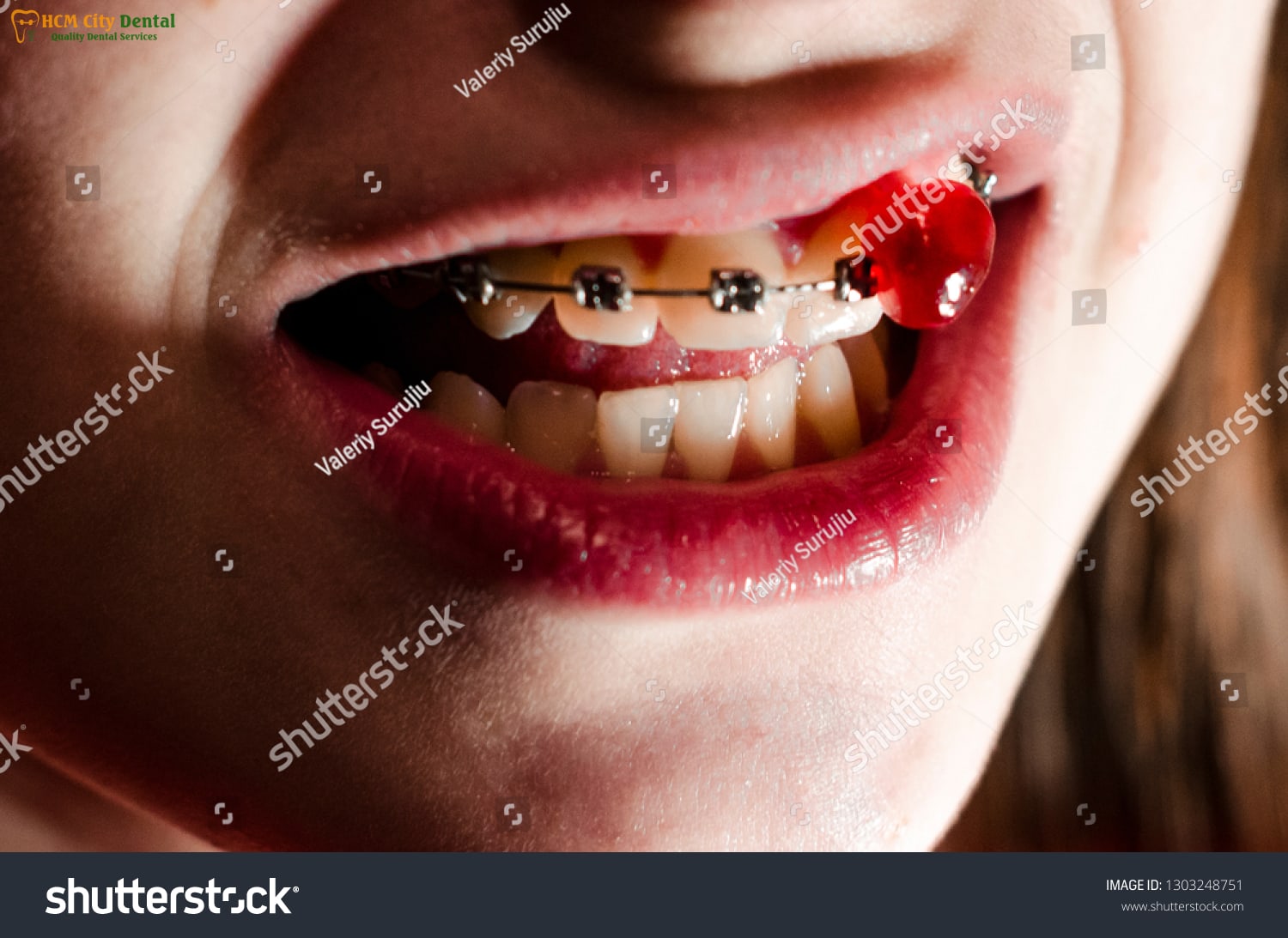 rang-hat-luu-2-bac-si-cuong-nha-khoa-bscuong-bac-si-cuong-nha-khoa-bscuong