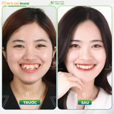 rang-khenh-dep-1-bac-si-cuong-nha-khoa-bscuong