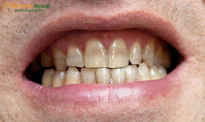 rang-nhiem-tetracycline-1-bac-si-cuong-nha-khoa-bscuong